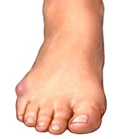 An illustration of a tailor's bunion.