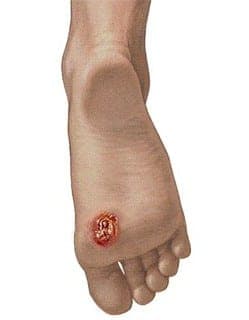 An illustration of a skin lesion.