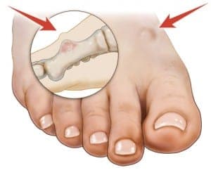 A protruding bone tumor.