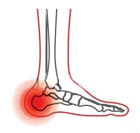 A highlighted image of heel pain.