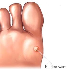 An illustration of a plantar wart.