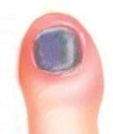 An illustration of a subungual hematoma.