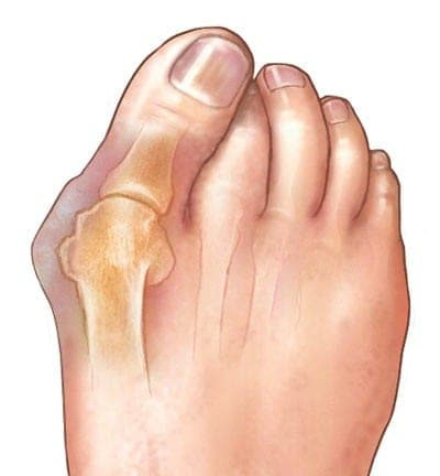 A bunion in the big toe.