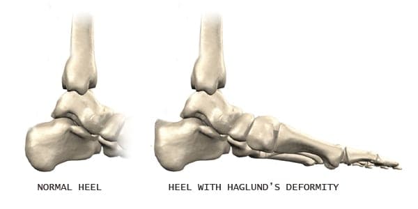 A comparison between a normal heel and one with Haglund's Deformities.