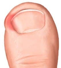 An illustration of an ingrown toenail.