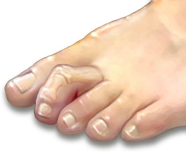 A nail lodged in a foot.