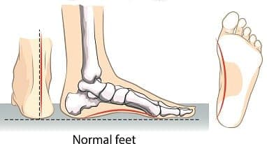 A normal foot.