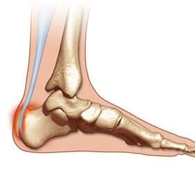 A heel with Haglund's Deformities.
