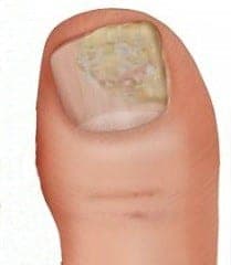 An illustration of toenail fungus.