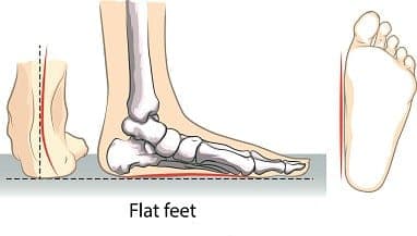 A flat foot.