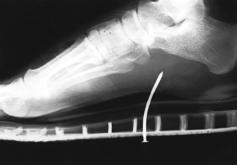 A nail lodged in a foot.