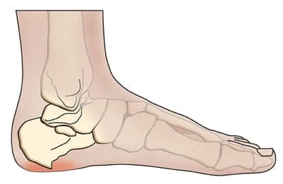 An image of an extending bone spur in the heel.