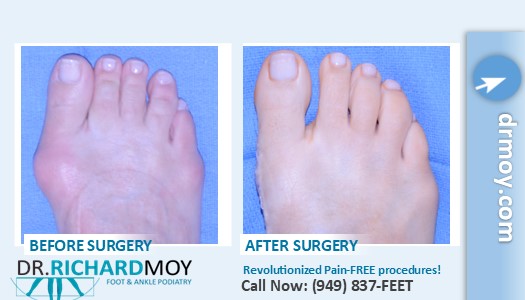 tailors bunion surgery before and after