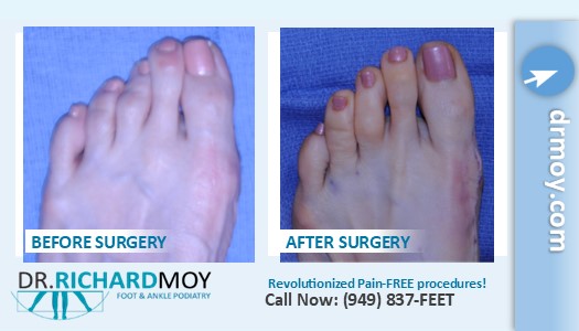 Before & After Bunion Surgery Photo Gallery, Los Angeles Foot Doctor