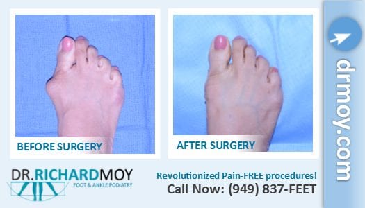 Podiatrists Vancouver Island, Bunions & Hammer Toes