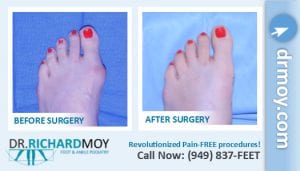 bunion removal