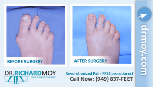 how to treat a bunion