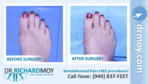 bunion images