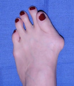 how to prevent bunions