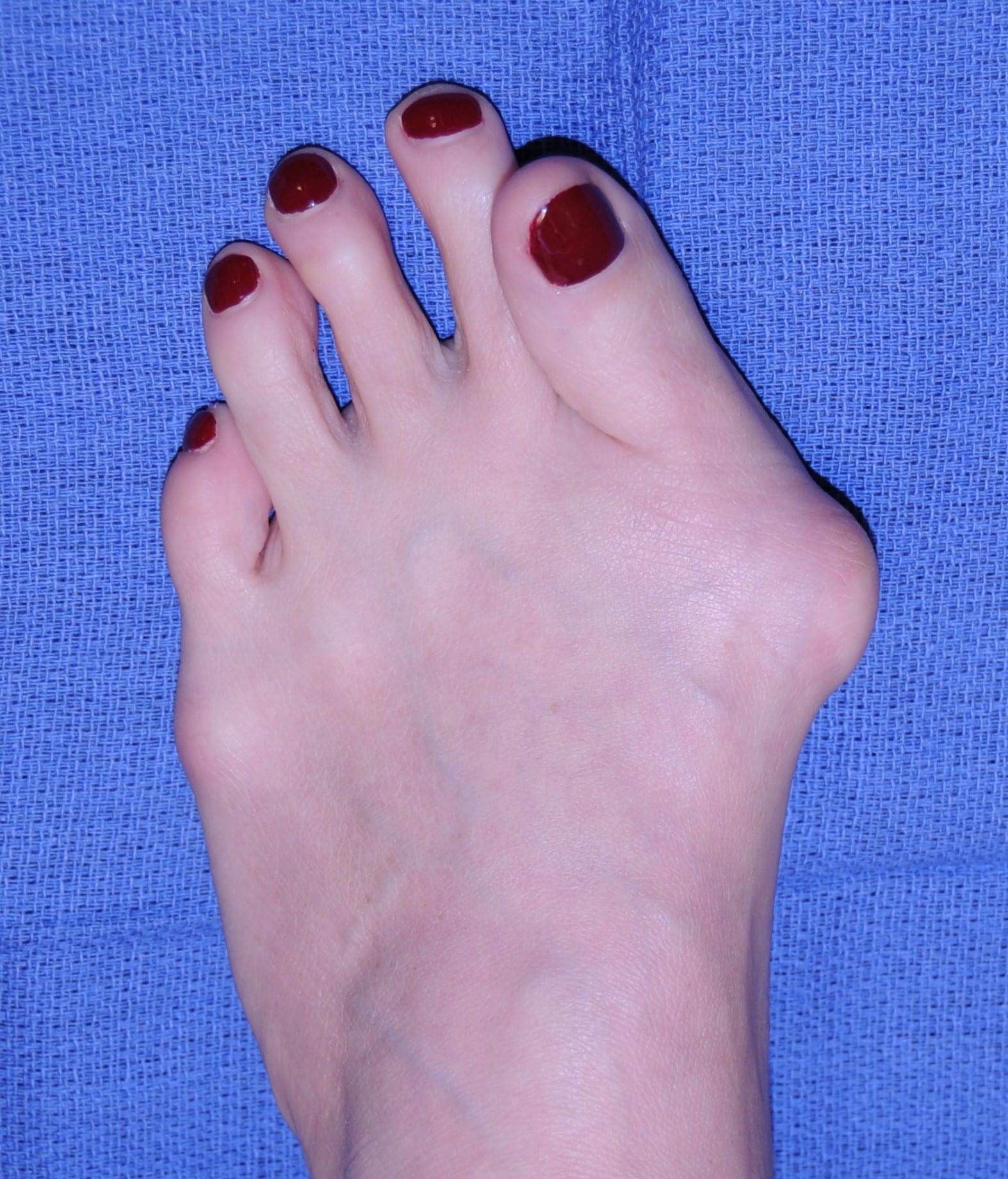 7-ways-to-treat-bunions-without-surgery-healthpartners-blog