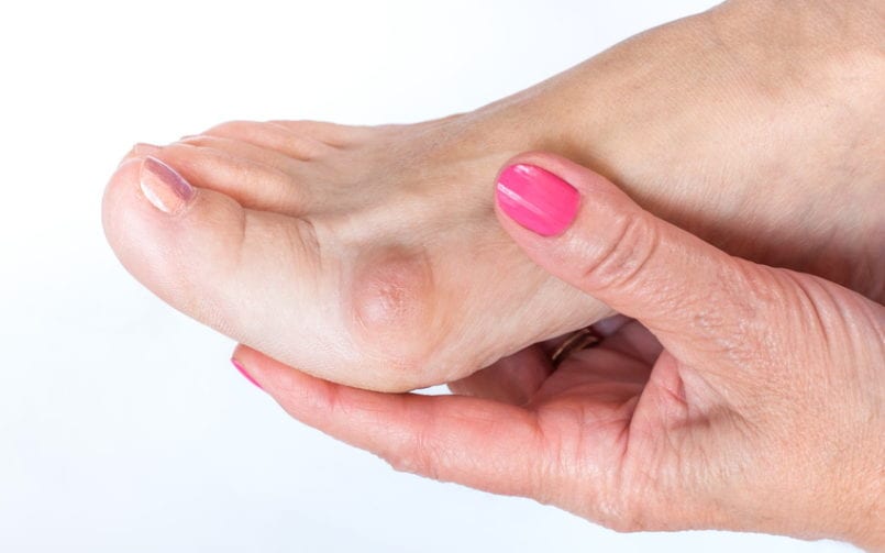 bunion pain